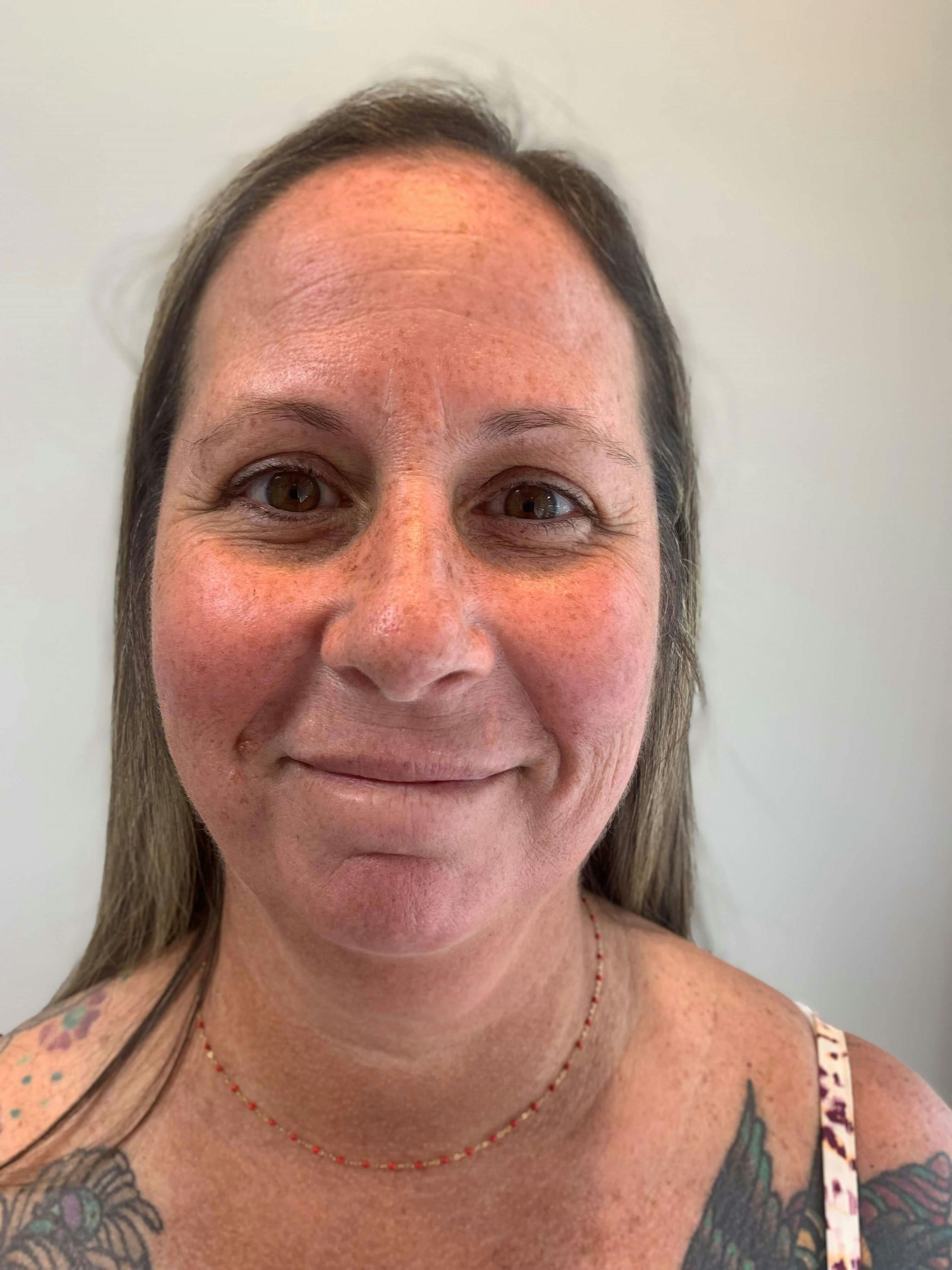 HydraFacial® Before & After Gallery - Patient 269732 - Image 1