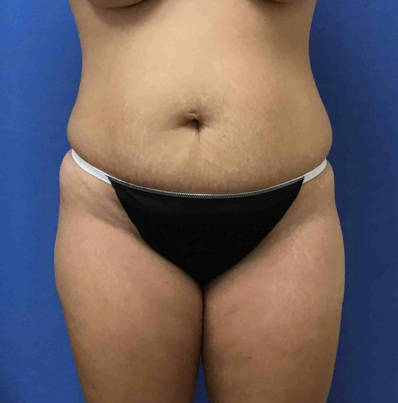 Tummy Tuck Before & After Gallery - Patient 137586 - Image 1