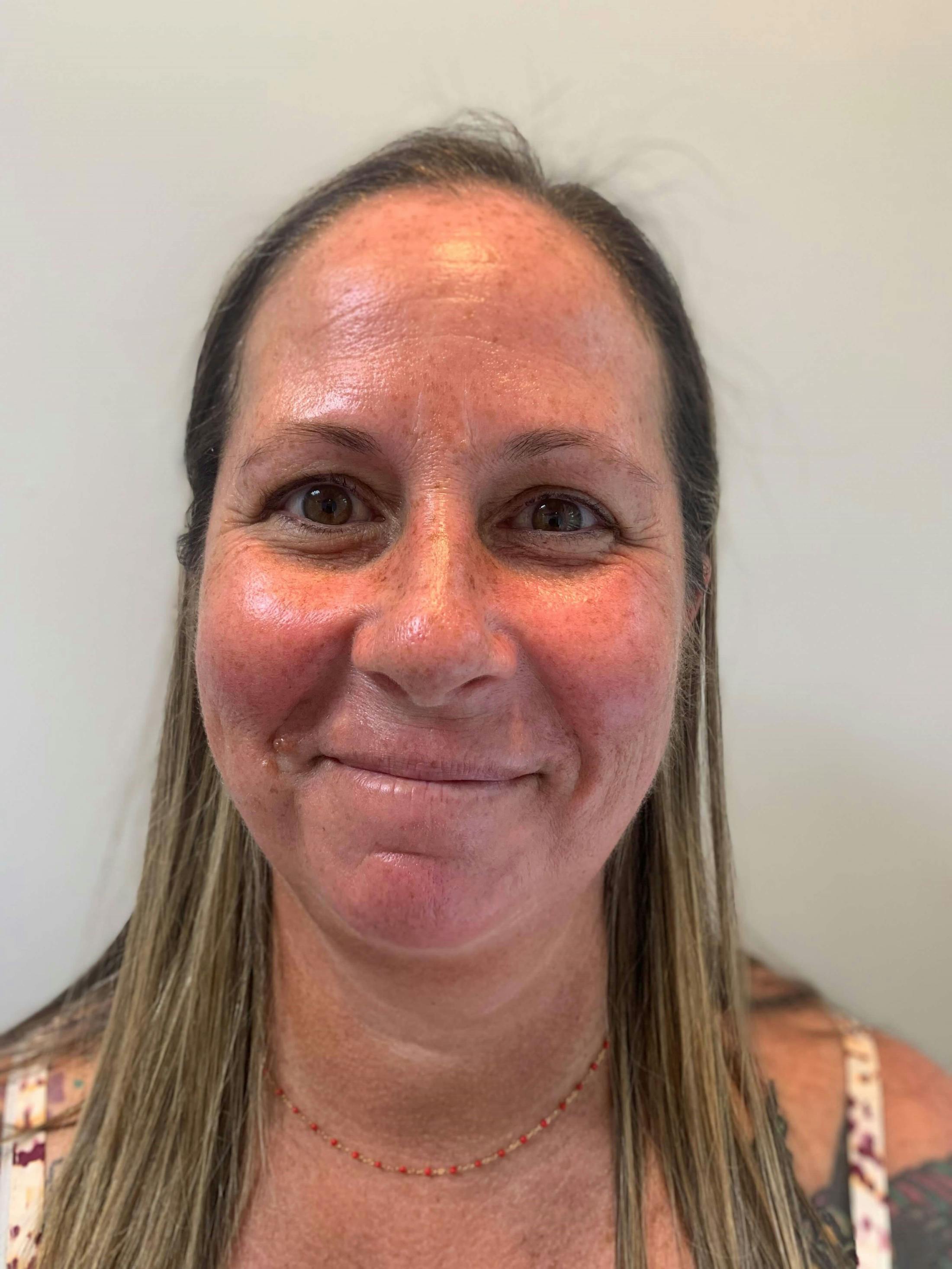 HydraFacial® Before & After Gallery - Patient 269732 - Image 2