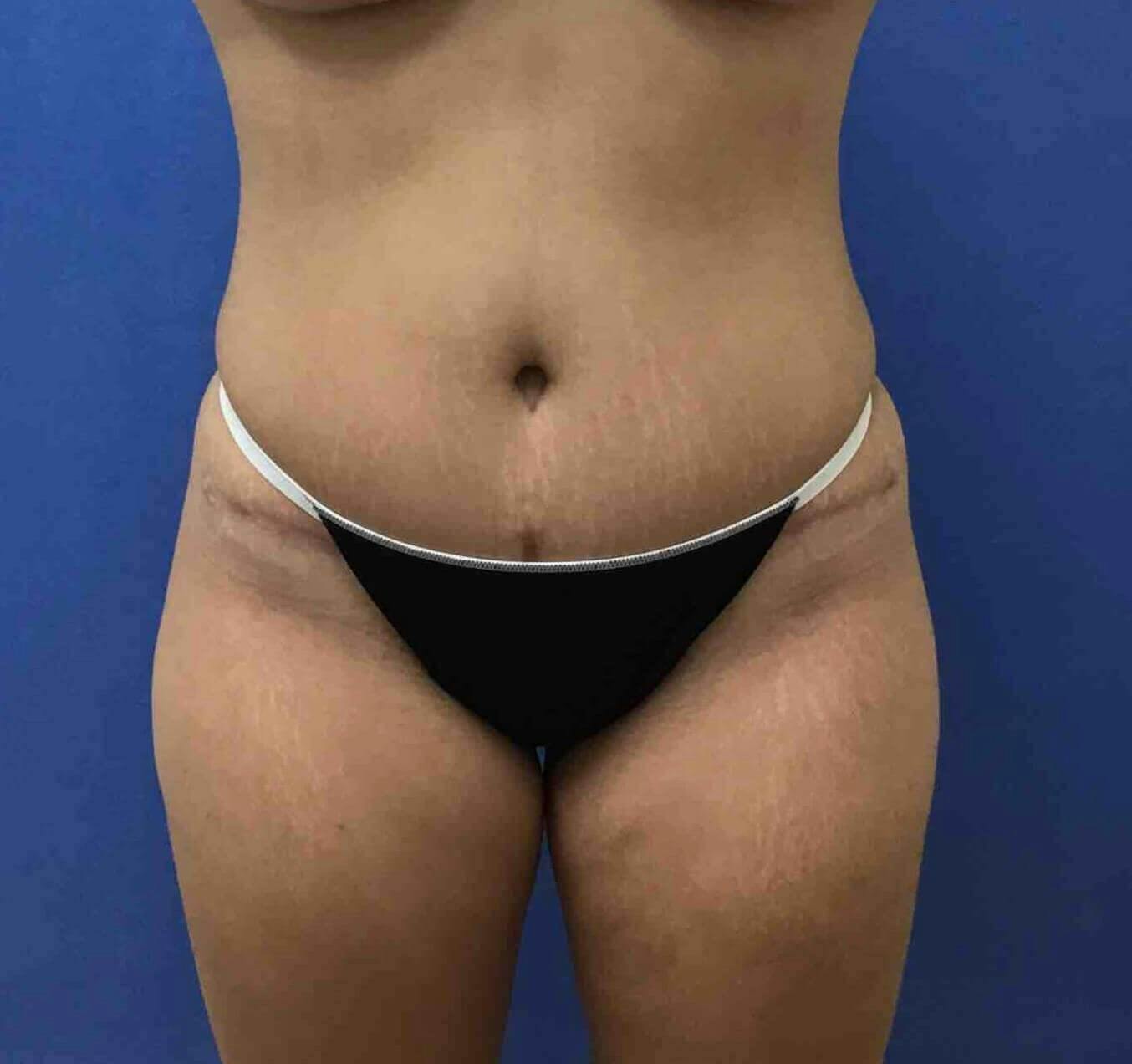 Tummy Tuck Before & After Gallery - Patient 137586 - Image 2