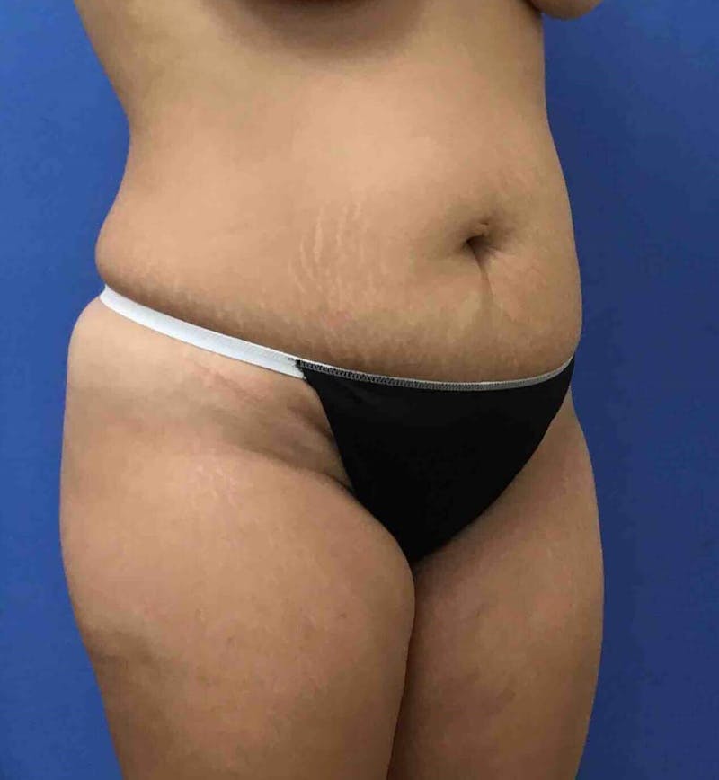 Tummy Tuck Before & After Gallery - Patient 137586 - Image 5