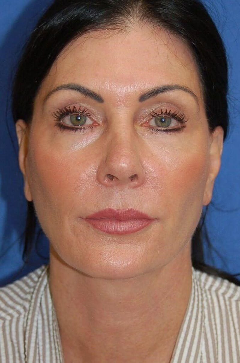 Face Lift Before & After Gallery - Patient 213163 - Image 2