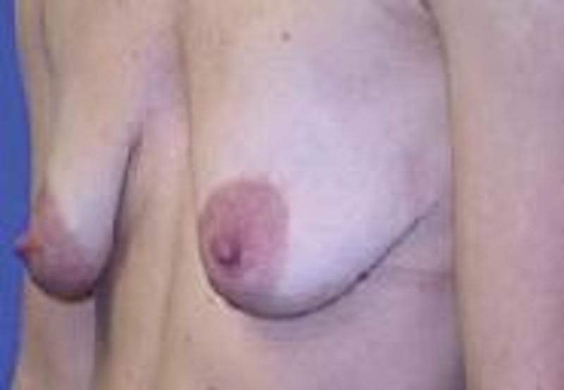 Breast Augmentation With Lift Before & After Gallery - Patient 304545 - Image 5