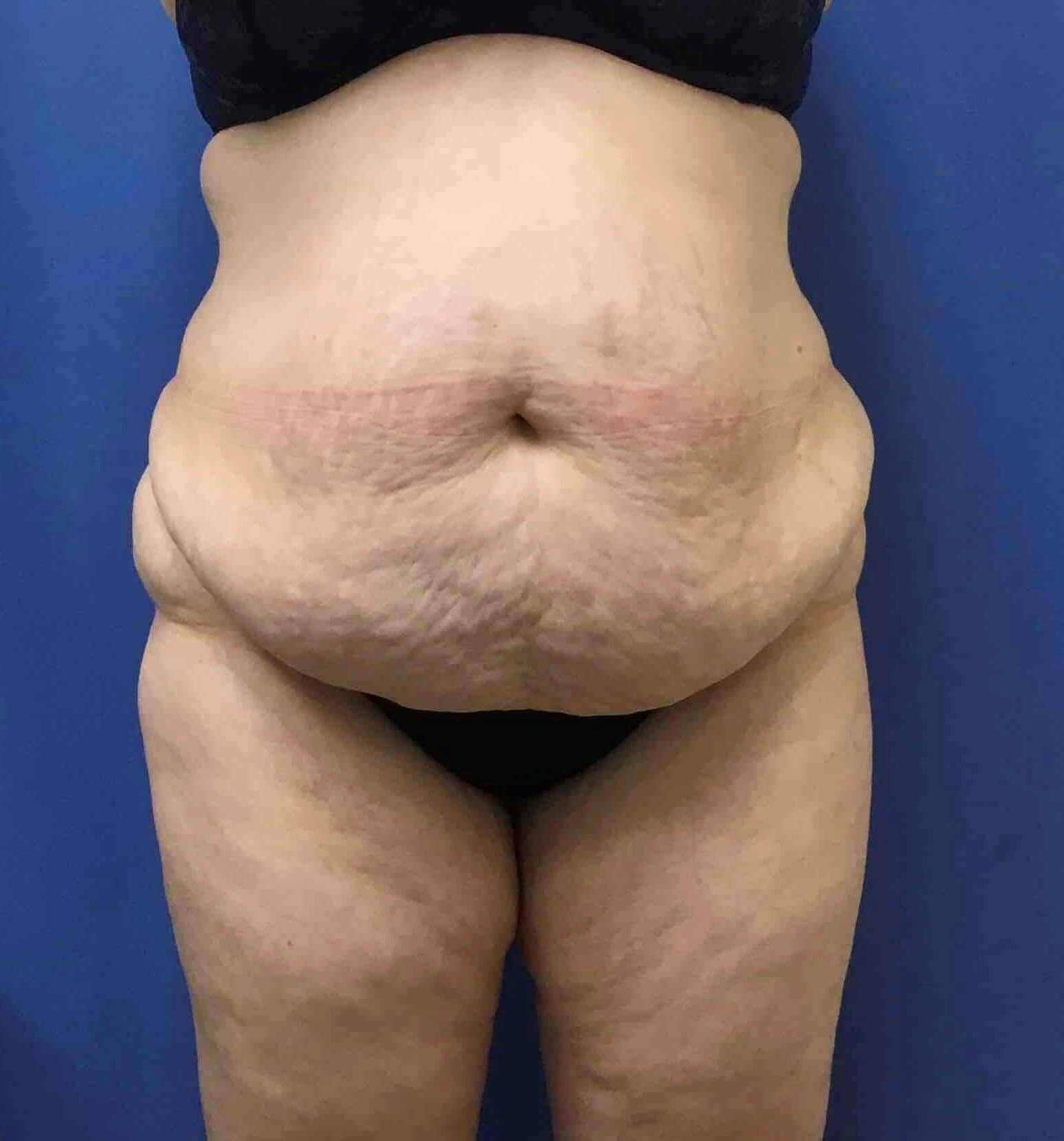 Tummy Tuck Before & After Gallery - Patient 351314 - Image 1