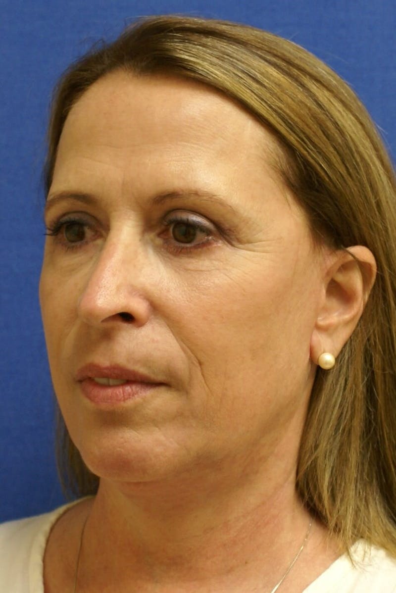 Face Lift Before & After Gallery - Patient 364455 - Image 2