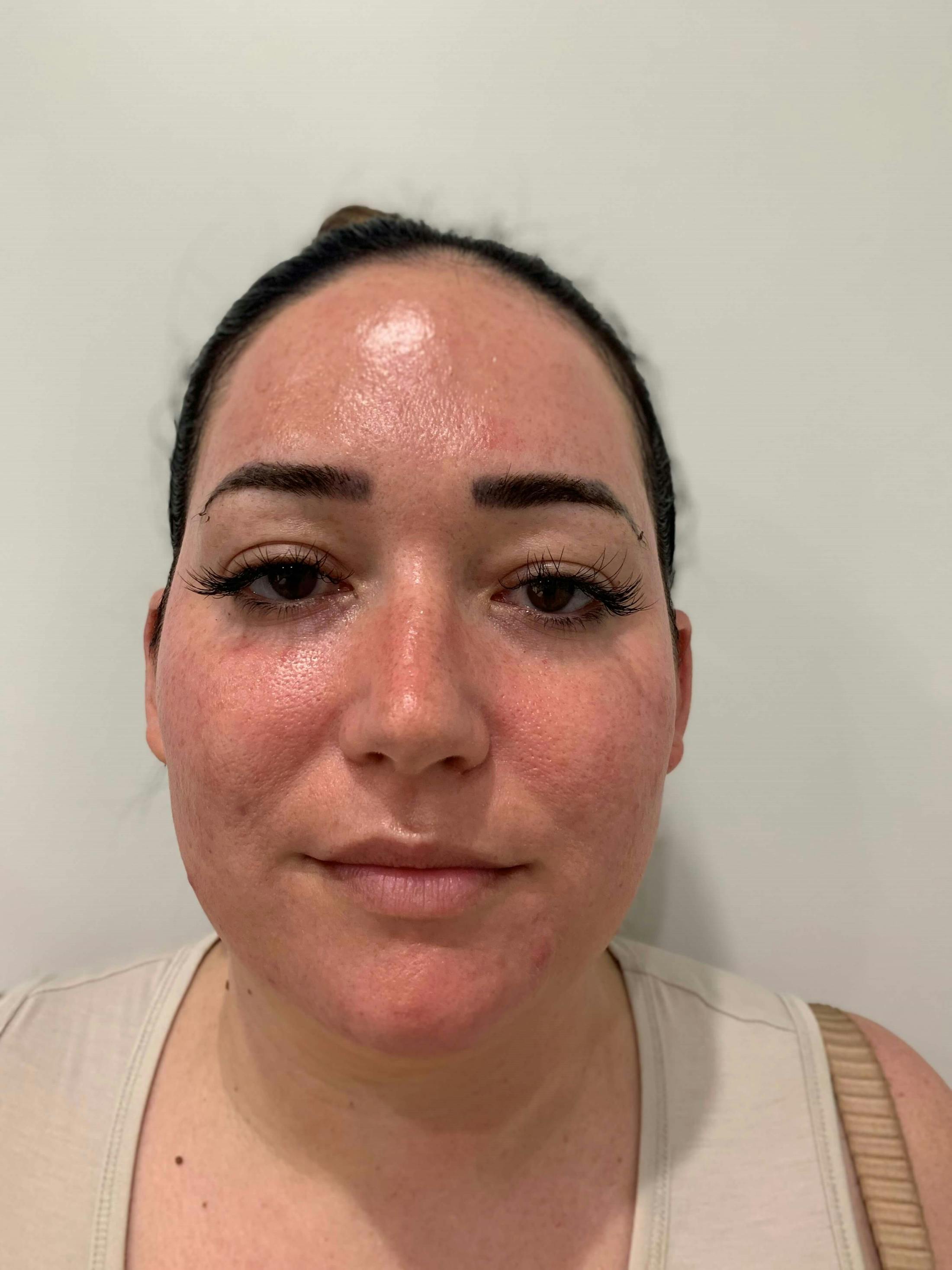 HydraFacial® Before & After Gallery - Patient 382519 - Image 2