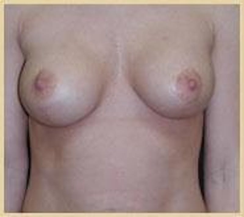 Breast Augmentation With Lift Before & After Gallery - Patient 206291 - Image 2