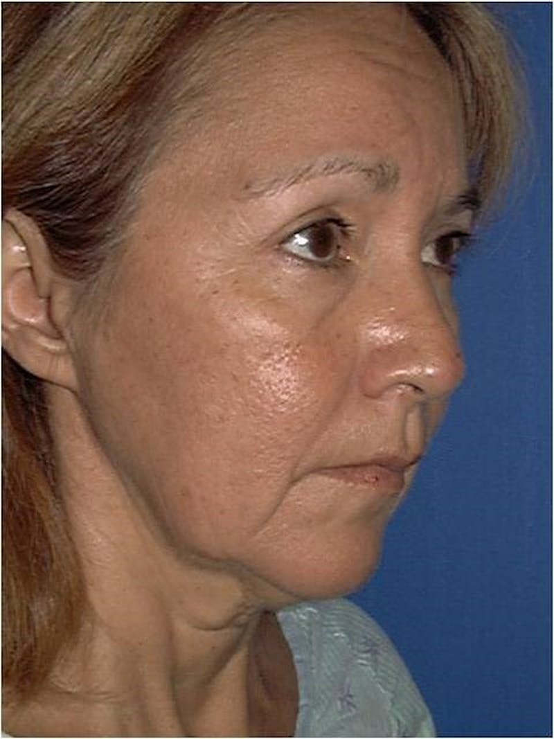 Face Lift Before & After Gallery - Patient 428324 - Image 3