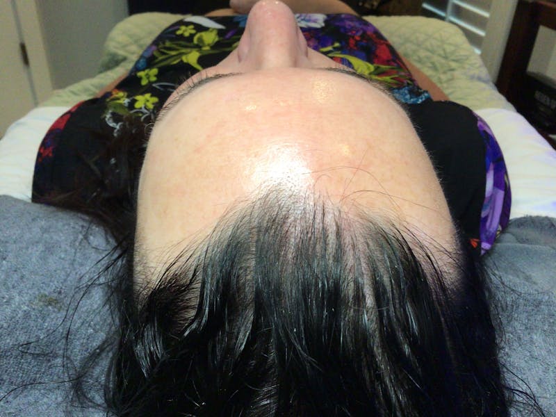 HydraFacial® Before & After Gallery - Patient 223465 - Image 1