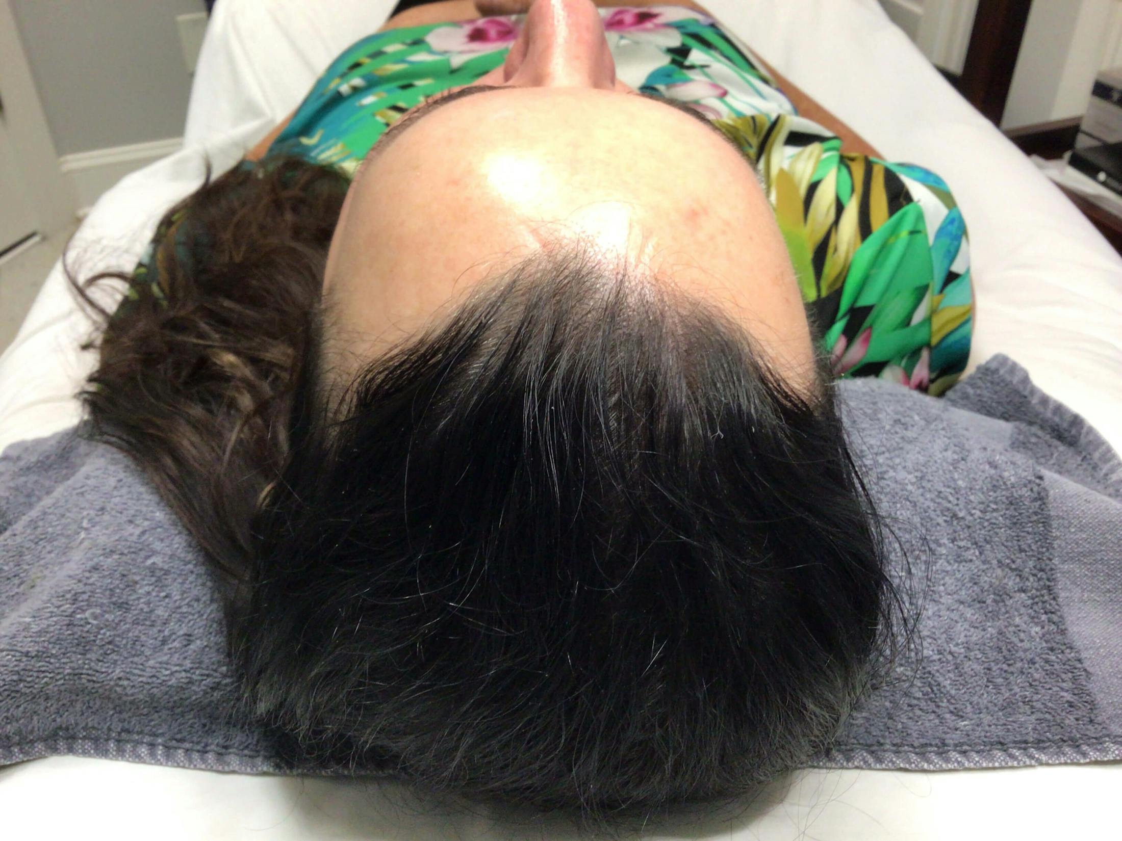 HydraFacial® Before & After Gallery - Patient 223465 - Image 2