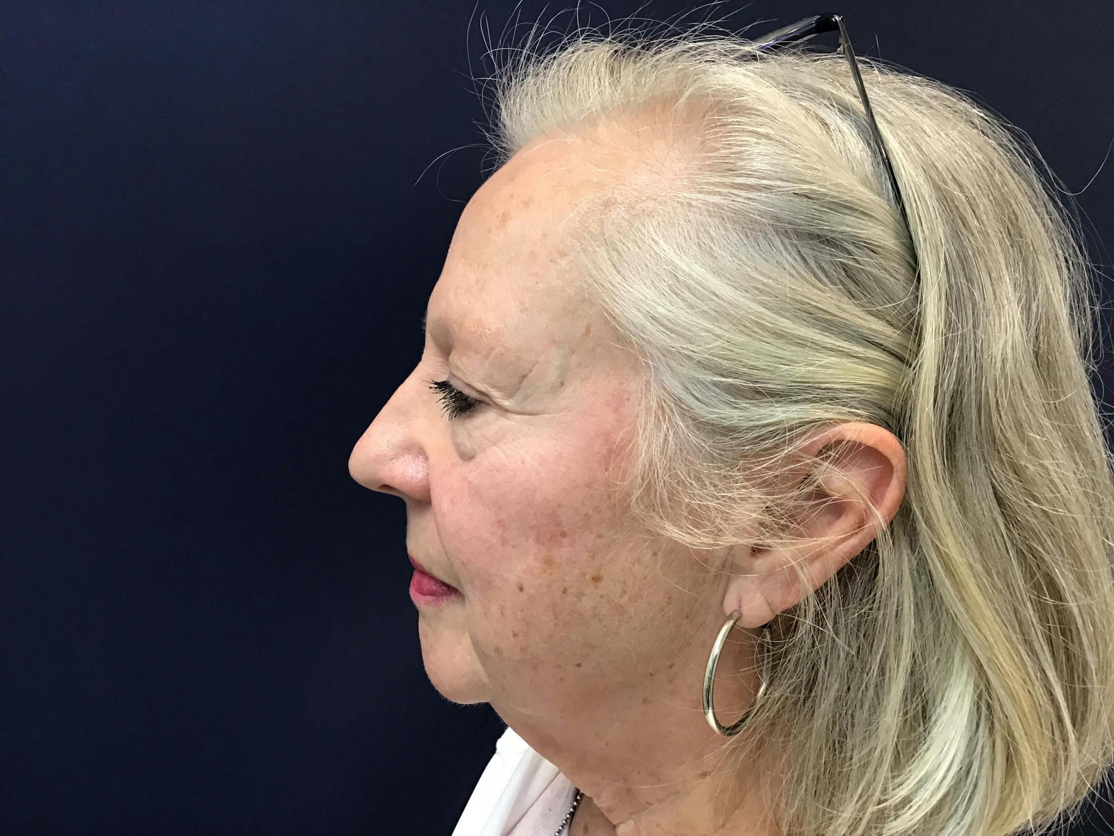 HydraFacial® Before & After Gallery - Patient 347182 - Image 1