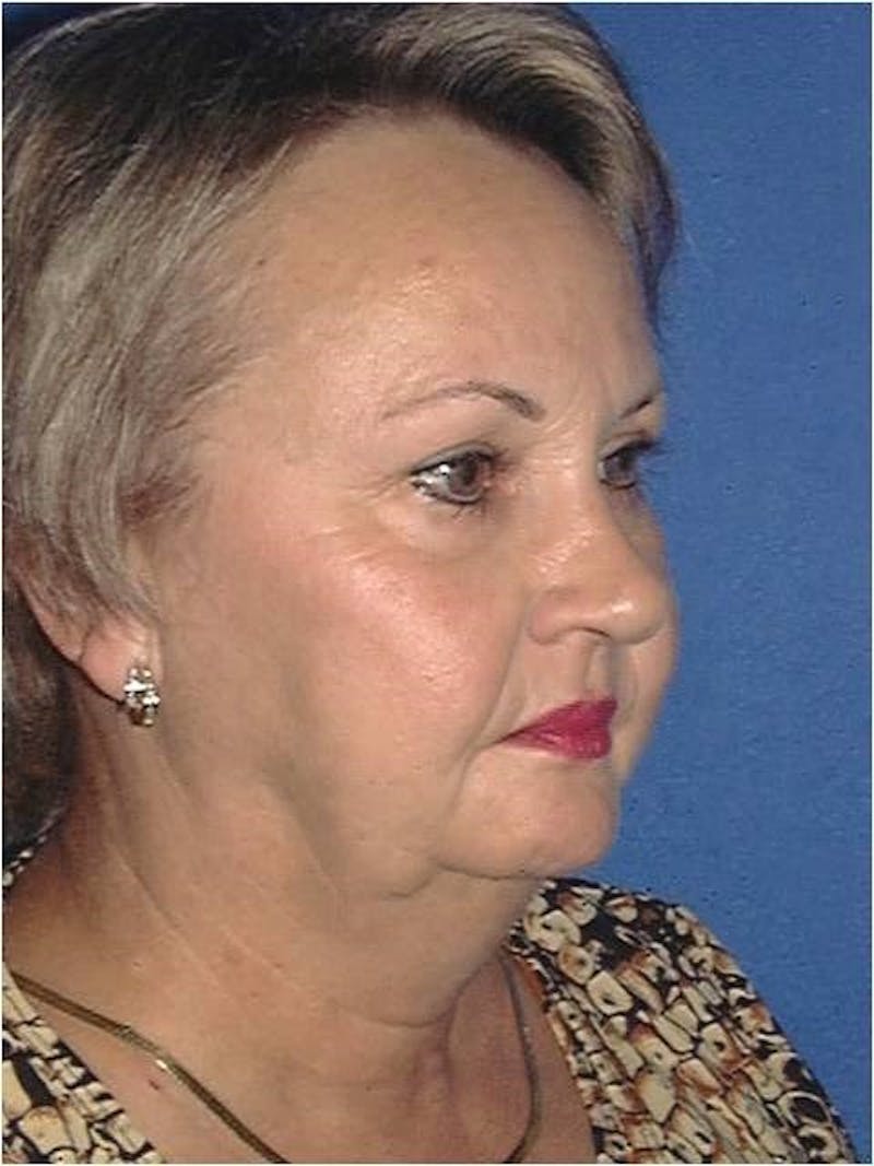 Face Lift Before & After Gallery - Patient 357925 - Image 1