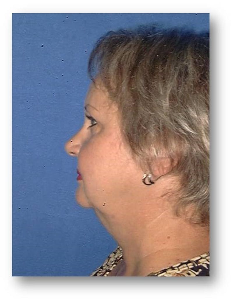 Face Lift Before & After Gallery - Patient 357925 - Image 3