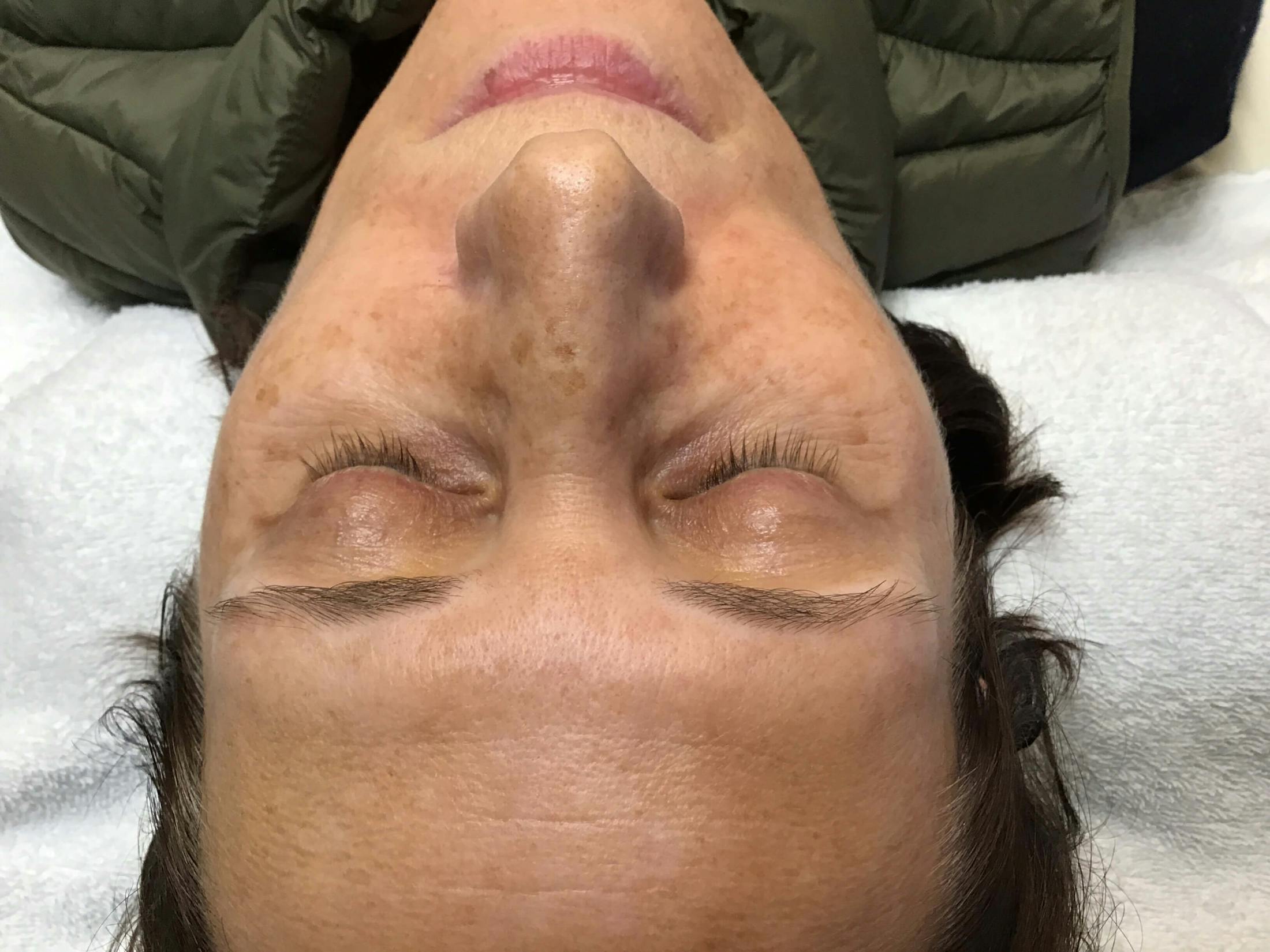 HydraFacial® Before & After Gallery - Patient 809400 - Image 1