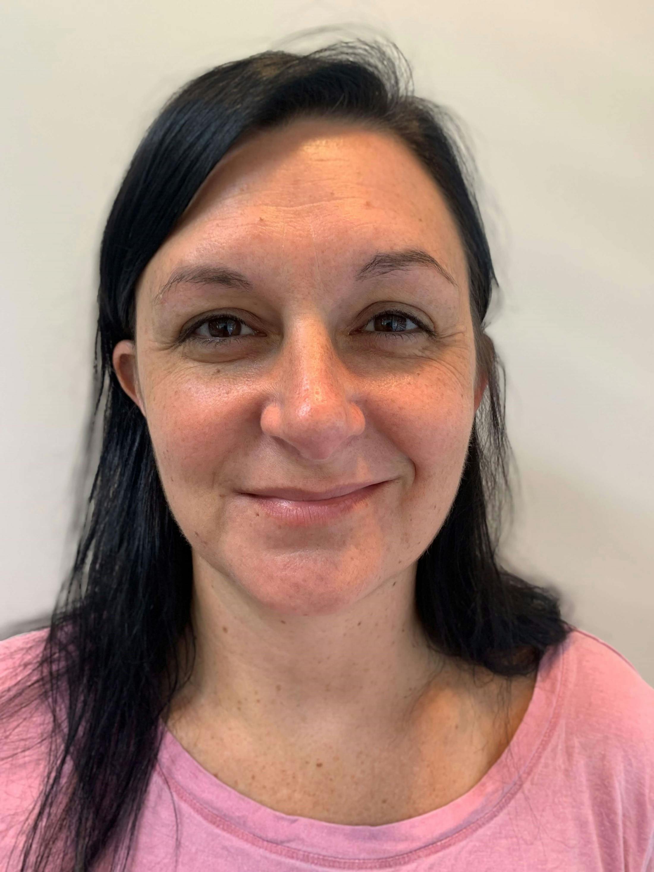 HydraFacial® Before & After Gallery - Patient 229016 - Image 1