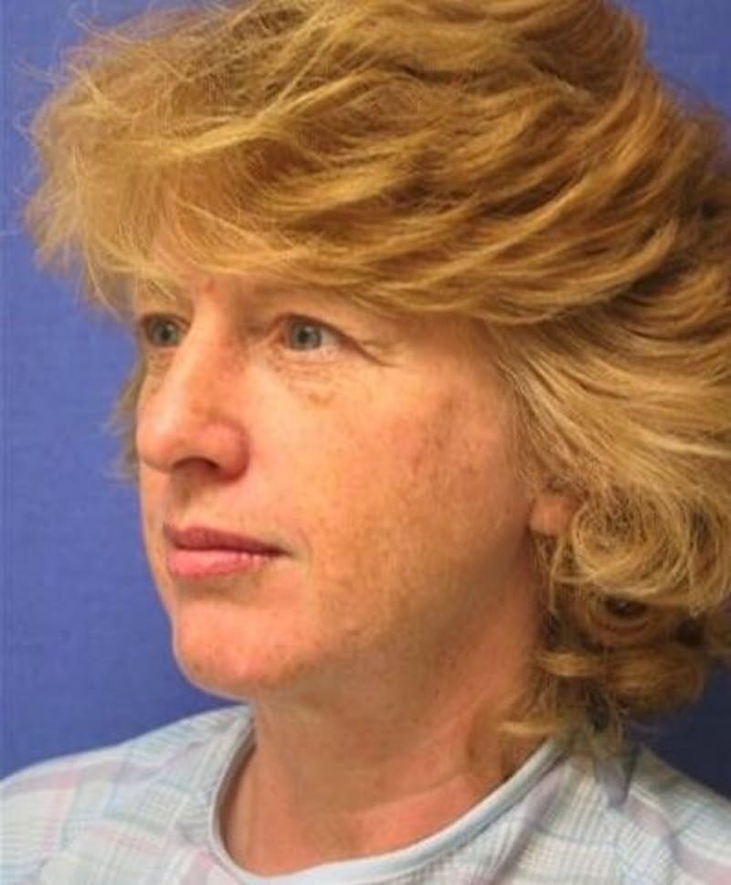 Face Lift Before & After Gallery - Patient 277526 - Image 1