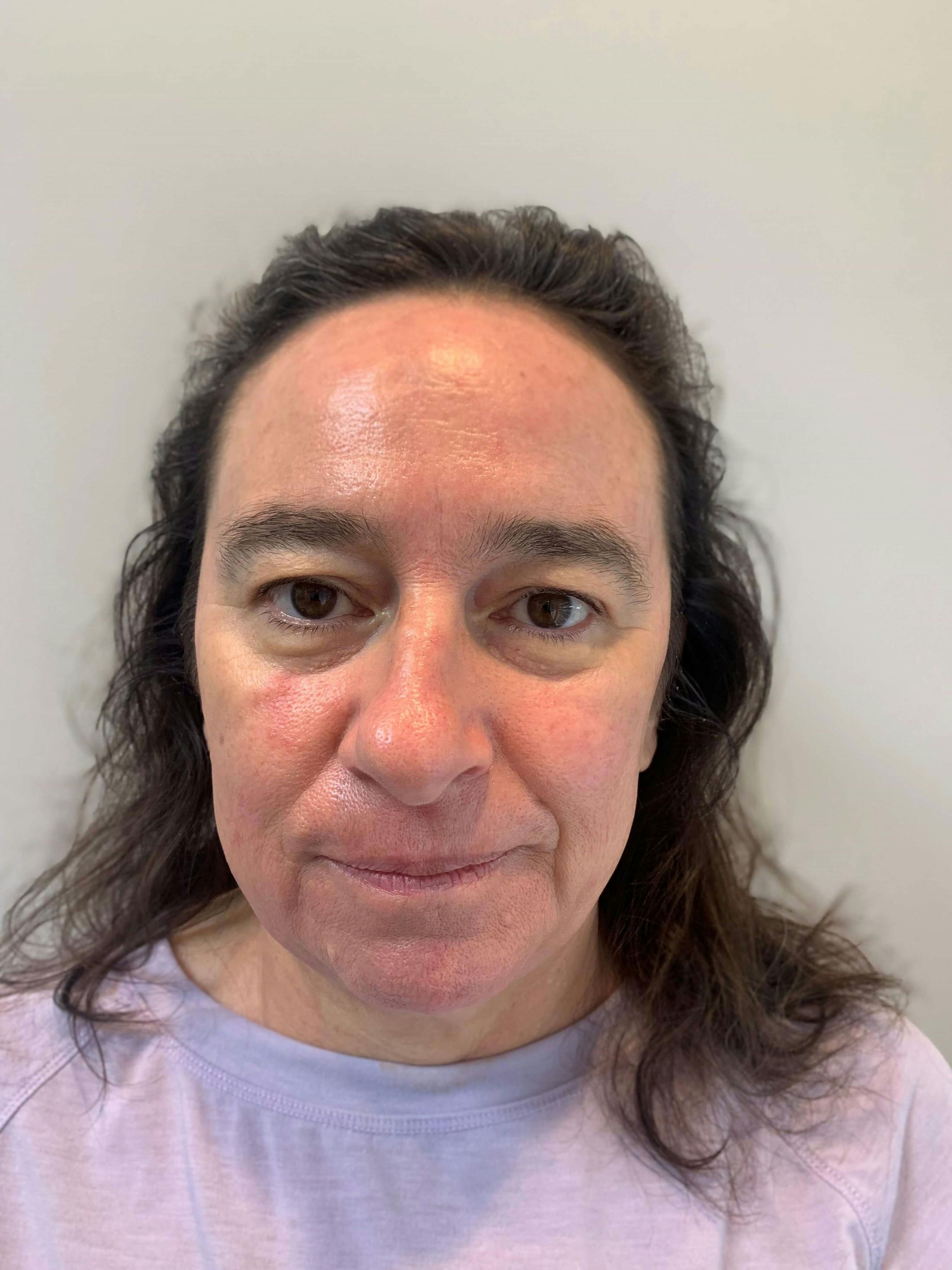 HydraFacial® Before & After Gallery - Patient 373870 - Image 2