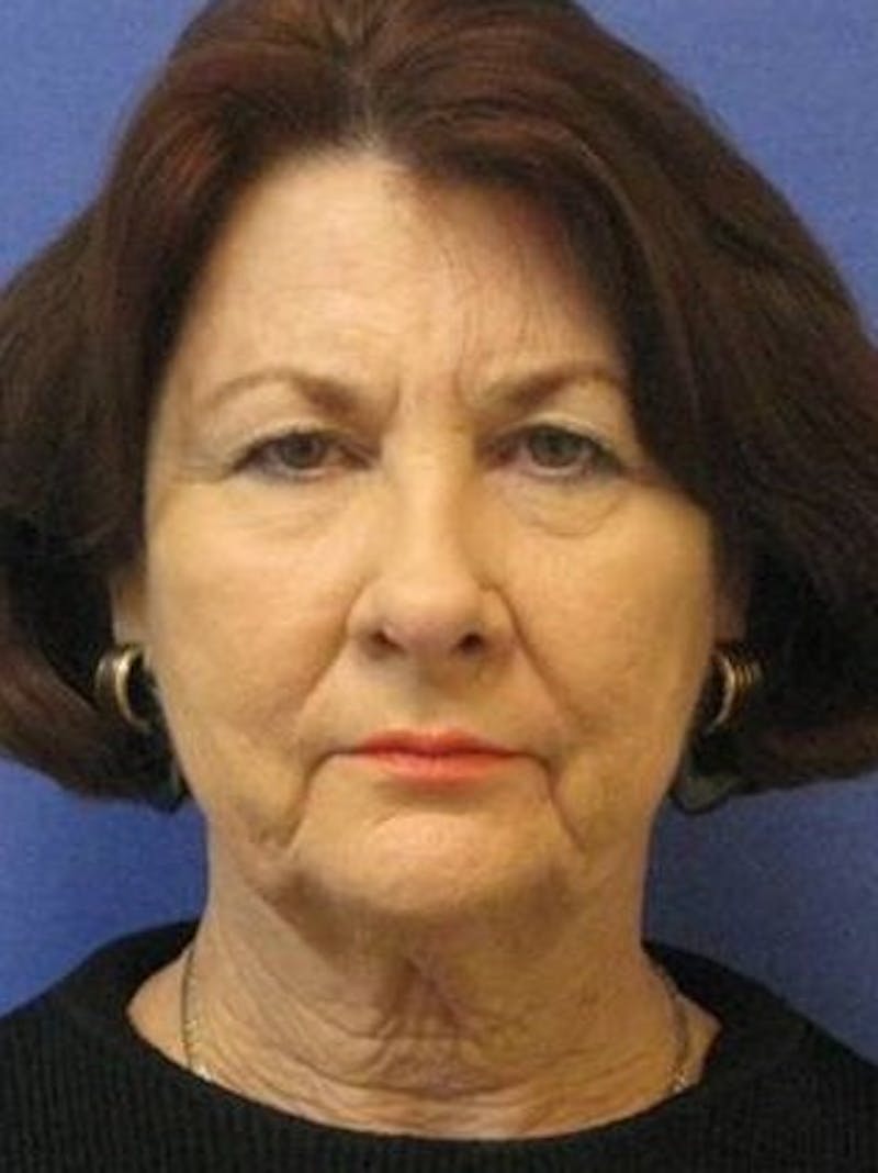 Face Lift Before & After Gallery - Patient 358778 - Image 1