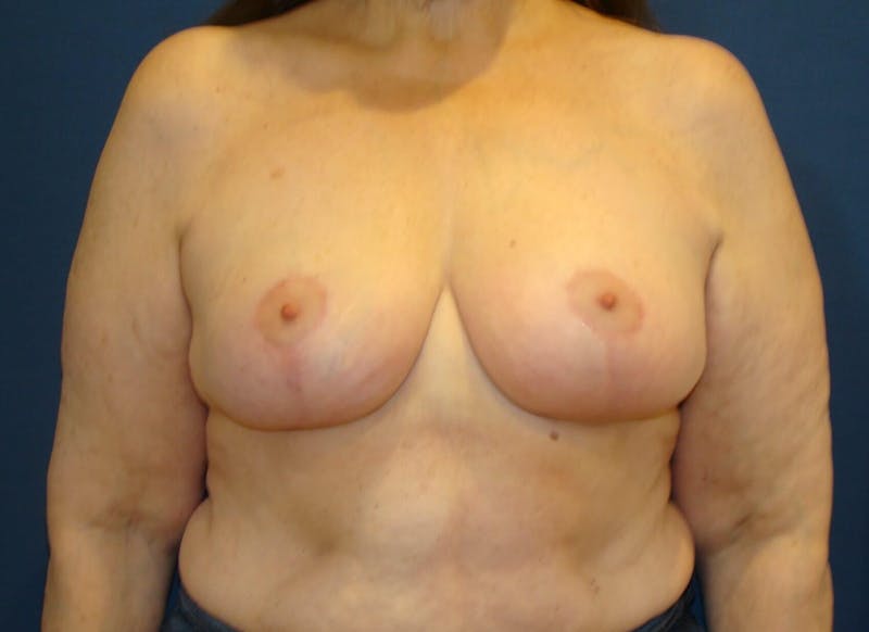 Breast Lift (Mastopexy) Before & After Gallery - Patient 408299 - Image 2