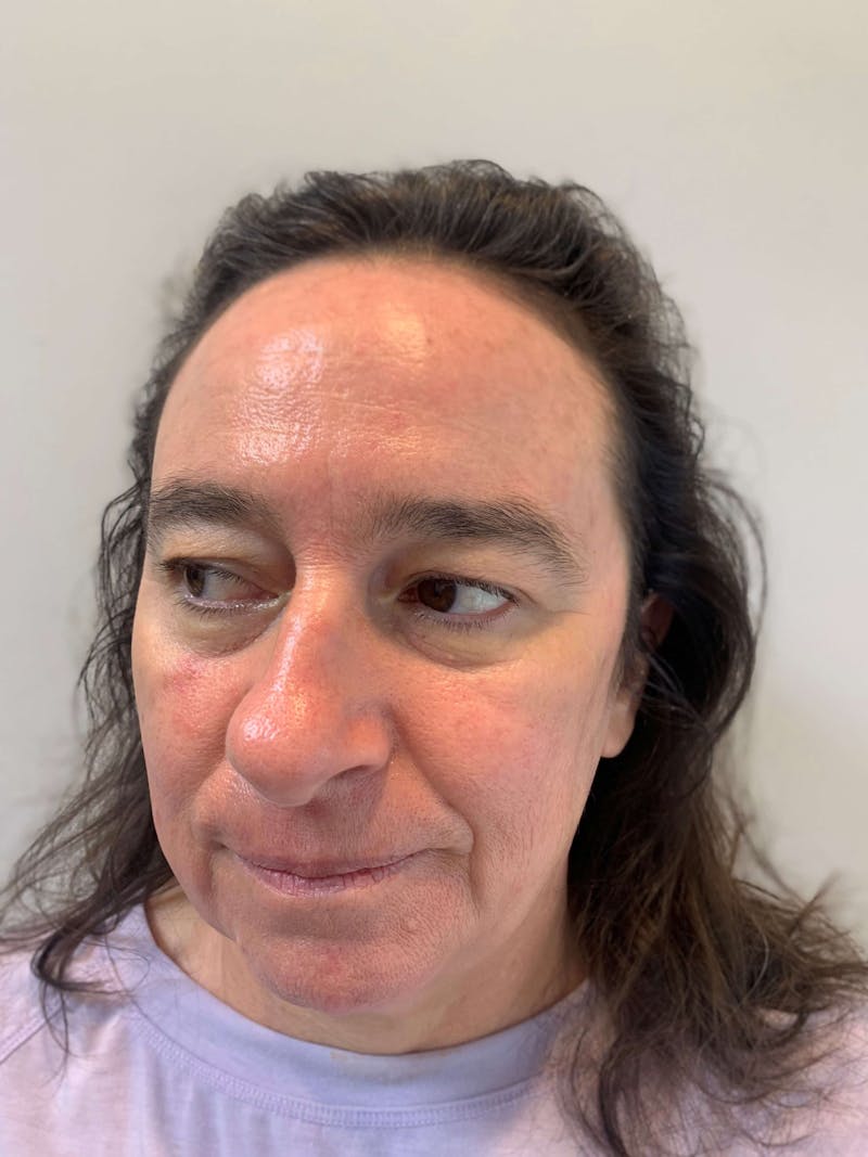 HydraFacial® Before & After Gallery - Patient 373870 - Image 6