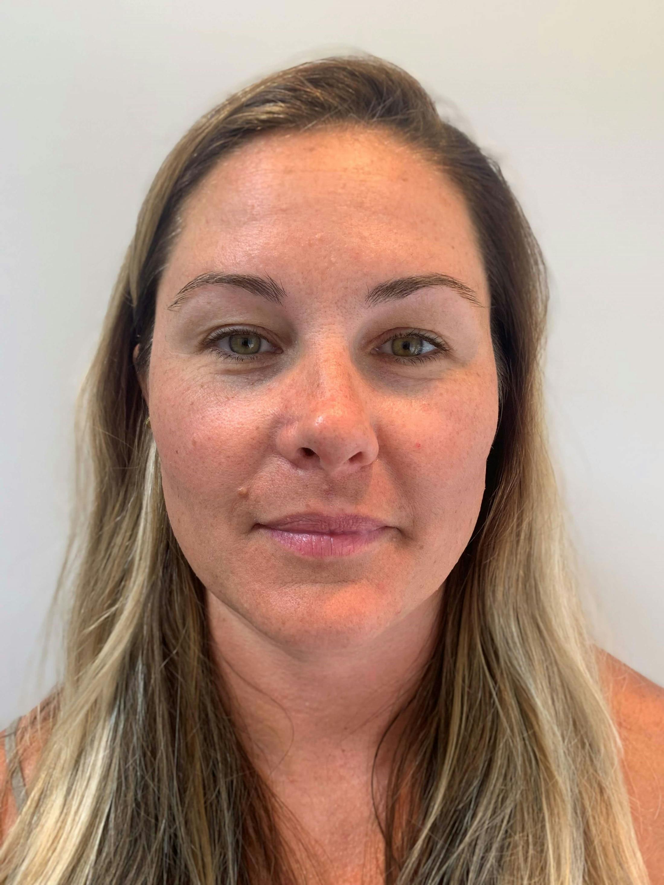 HydraFacial® Before & After Gallery - Patient 243048 - Image 1
