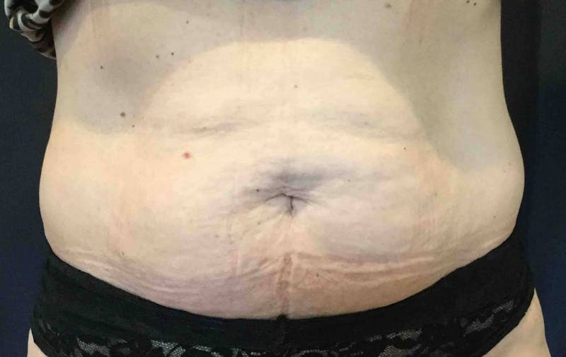 SculpSure™ Before & After Gallery - Patient 382728 - Image 1