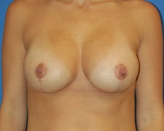 Breast Augmentation With Lift Before & After Gallery - Patient 361060 - Image 2