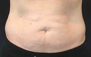 SculpSure™ Before & After Gallery - Patient 382728 - Image 2