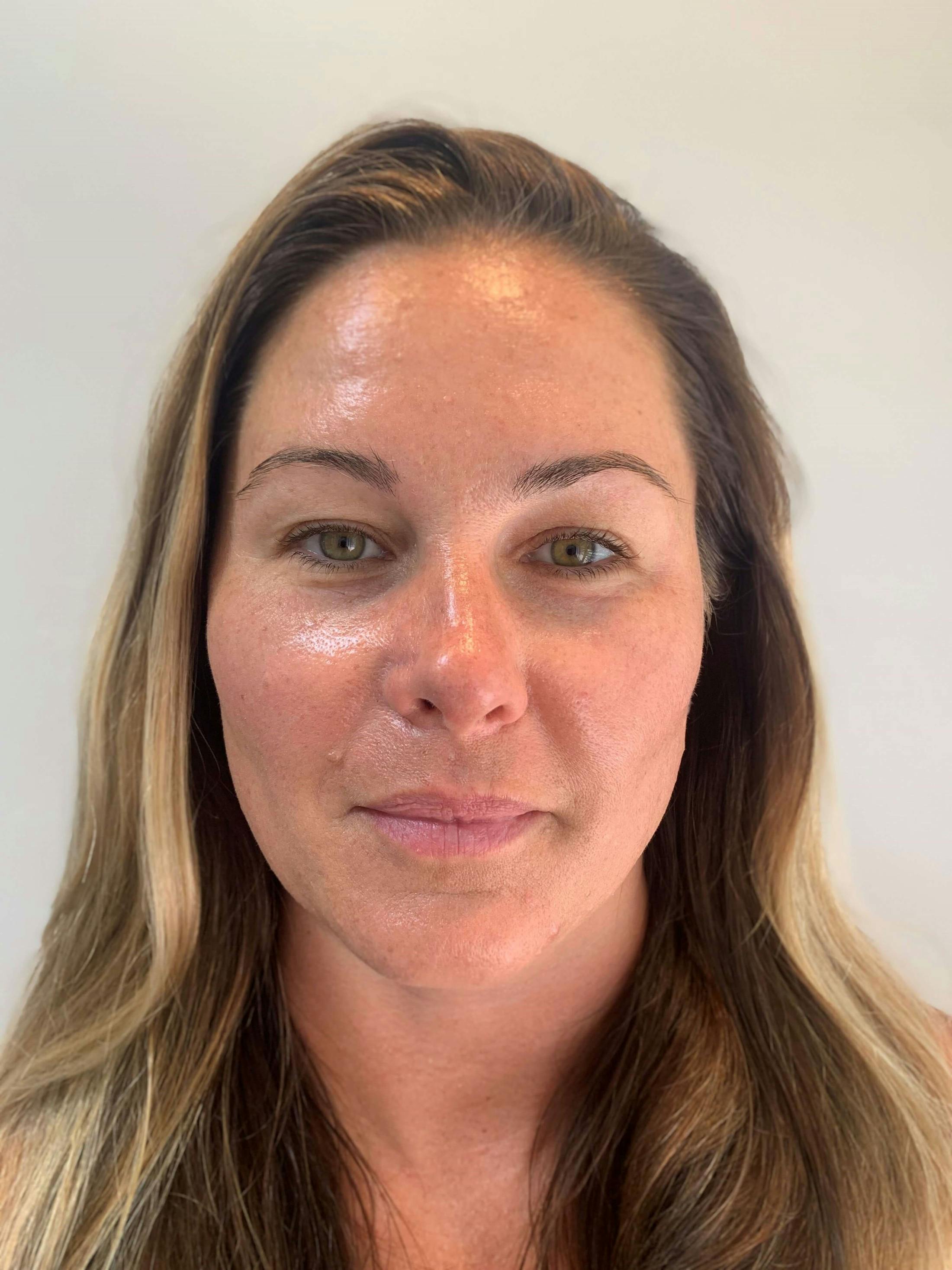 HydraFacial® Before & After Gallery - Patient 243048 - Image 2