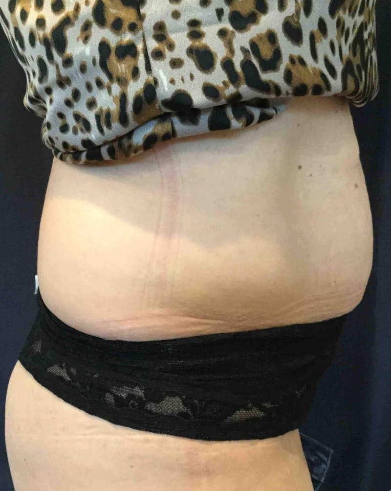SculpSure™ Before & After Gallery - Patient 382728 - Image 3