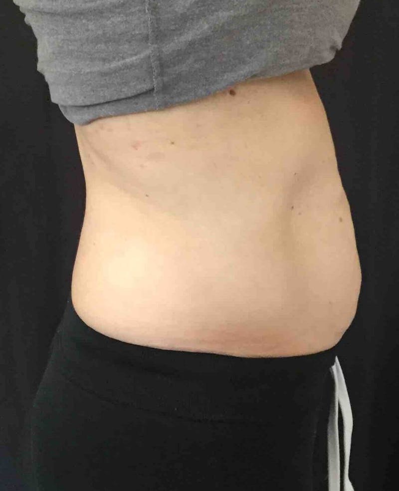 SculpSure™ Before & After Gallery - Patient 382728 - Image 4