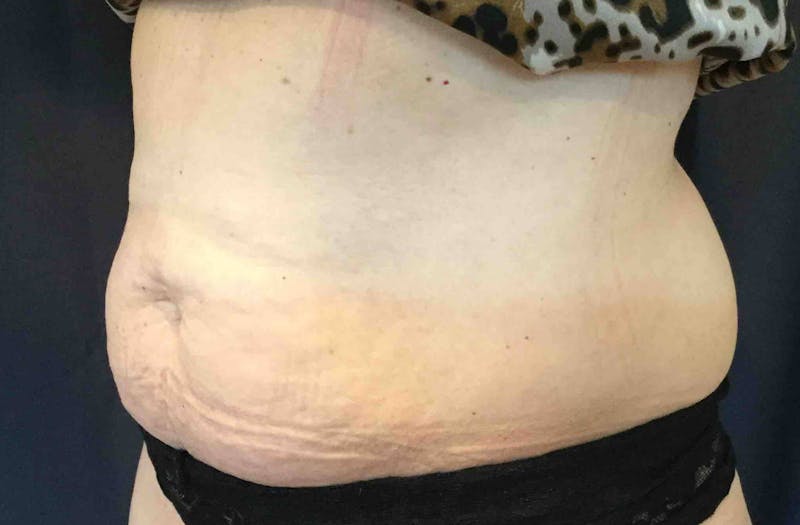 SculpSure™ Before & After Gallery - Patient 382728 - Image 5