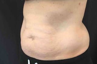 SculpSure™ Before & After Gallery - Patient 382728 - Image 6