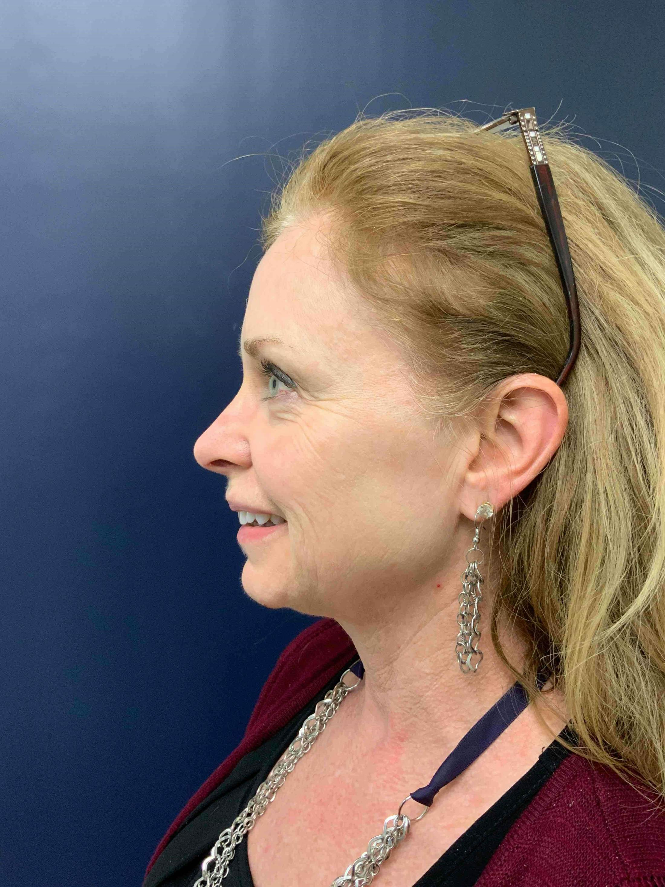 BBL™ Laser Before & After Gallery - Patient 135492 - Image 2