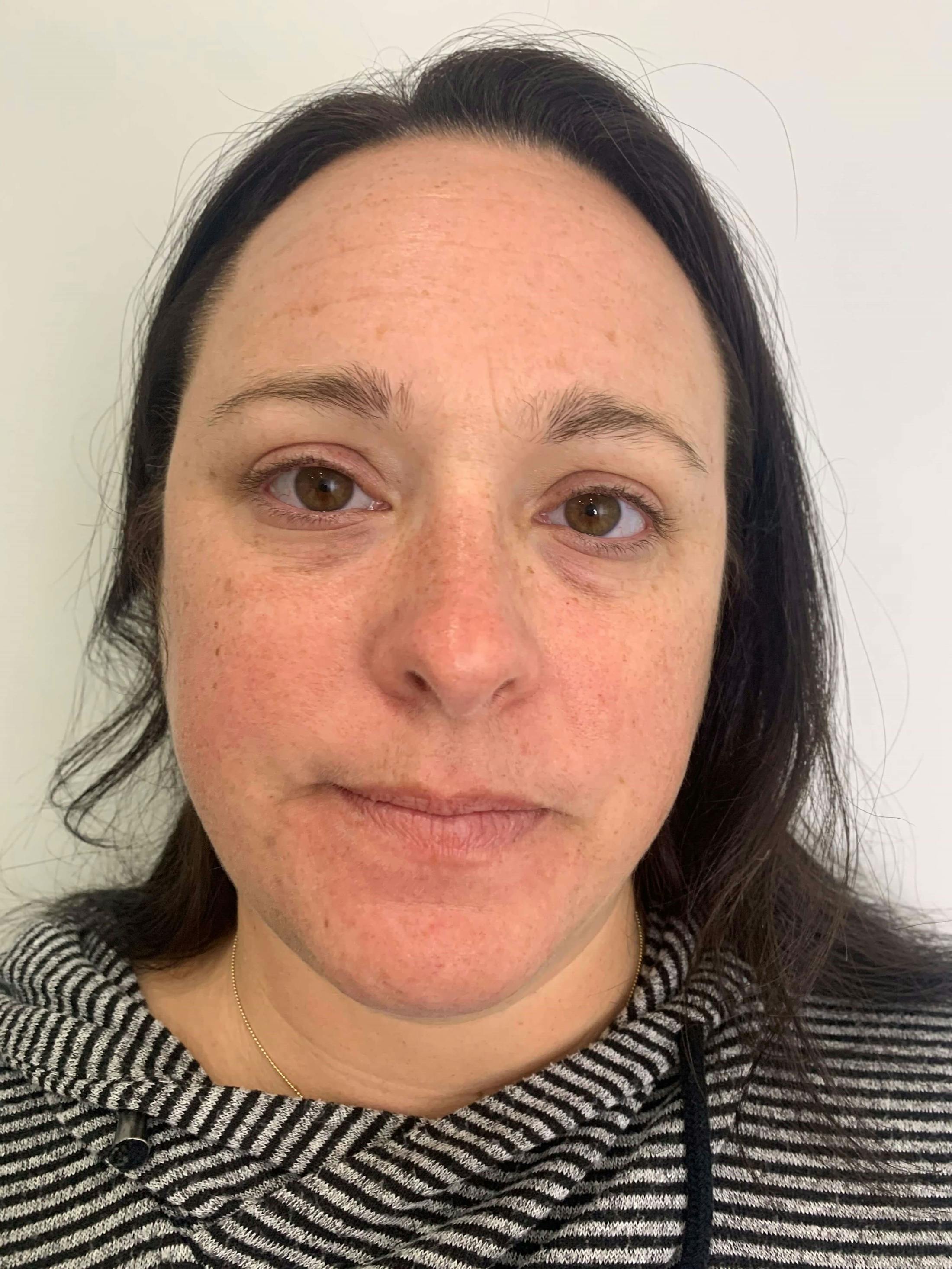 HydraFacial® Before & After Gallery - Patient 850654 - Image 1