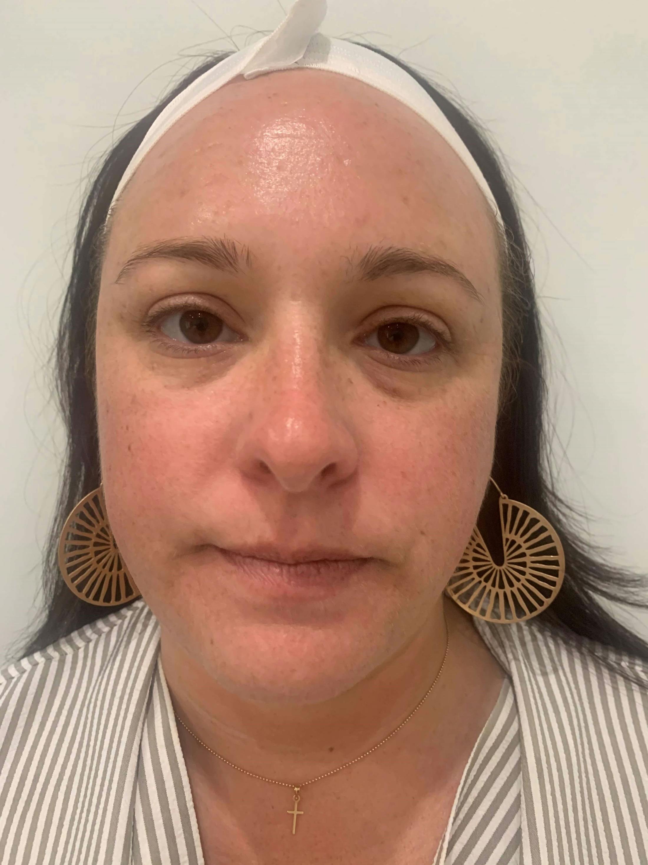 HydraFacial® Before & After Gallery - Patient 850654 - Image 2