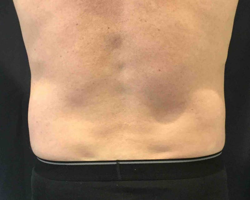 SculpSure™ Before & After Gallery - Patient 306172 - Image 2