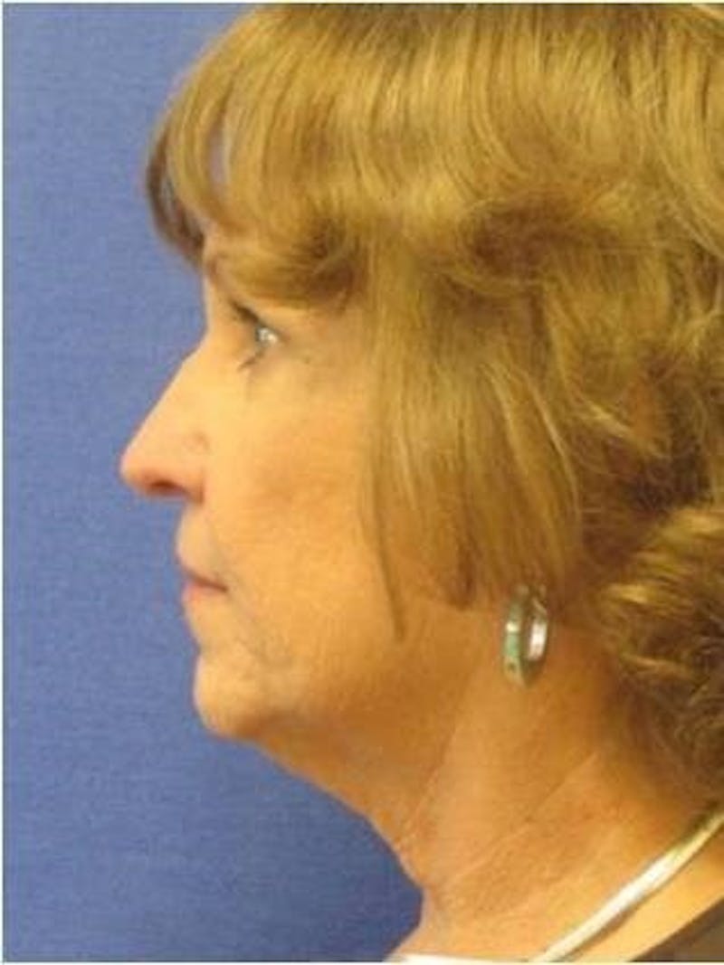 Face Lift Before & After Gallery - Patient 388025 - Image 1