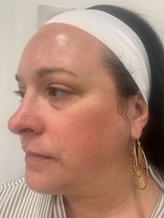 HydraFacial® Before & After Gallery - Patient 850654 - Image 4