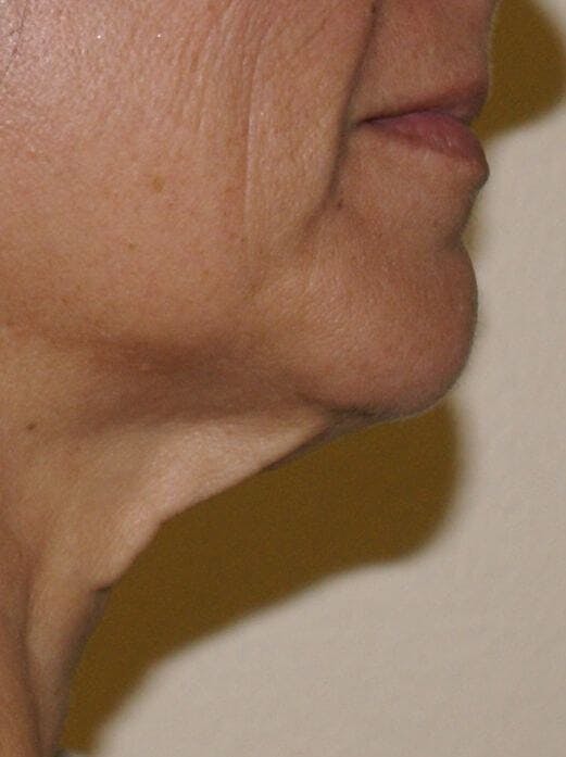 ThermiTight™ Before & After Gallery - Patient 221799 - Image 1