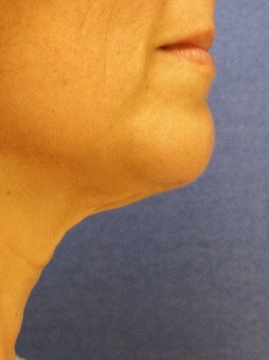 ThermiTight™ Before & After Gallery - Patient 221799 - Image 2
