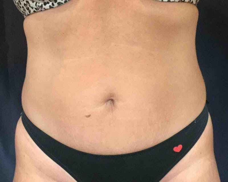 SculpSure™ Before & After Gallery - Patient 289370 - Image 4