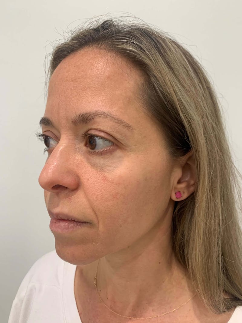 HydraFacial® Before & After Gallery - Patient 162548 - Image 3