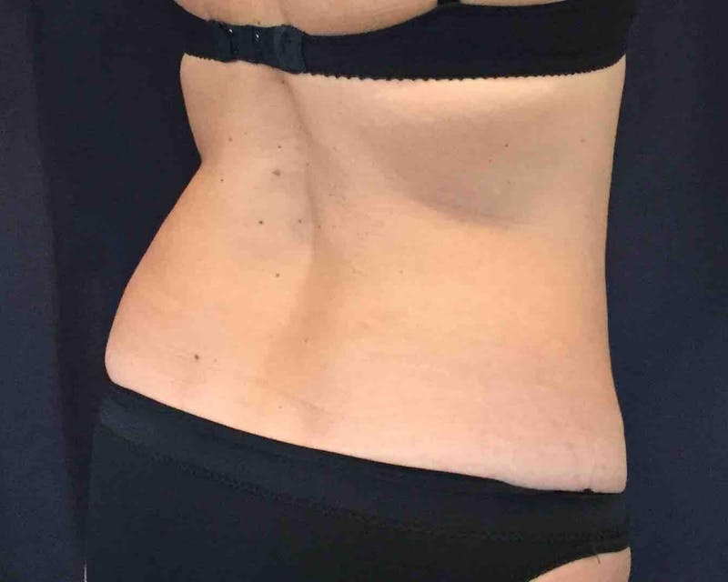 SculpSure™ Before & After Gallery - Patient 343279 - Image 6