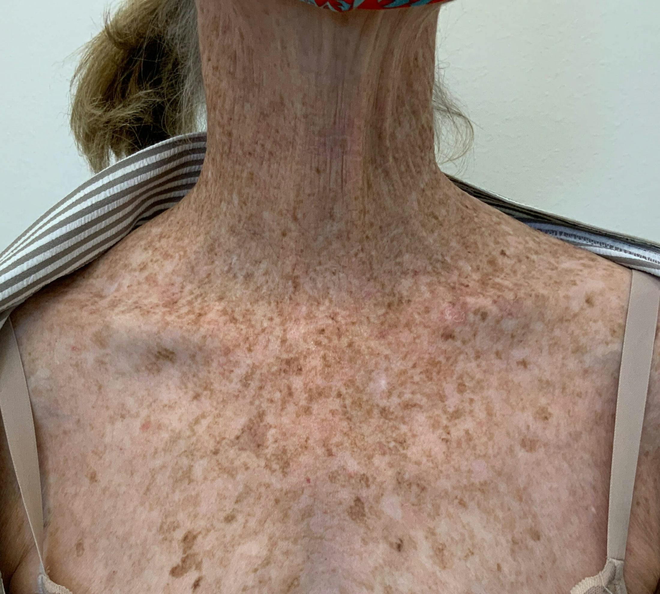 BBL™ Laser Before & After Gallery - Patient 257669 - Image 1