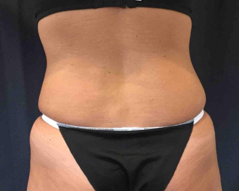 SculpSure™ Before & After Gallery - Patient 148713 - Image 2