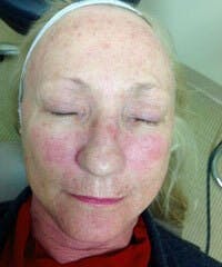 BBL™ Laser Before & After Gallery - Patient 418082 - Image 1