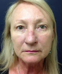 BBL™ Laser Before & After Gallery - Patient 418082 - Image 2