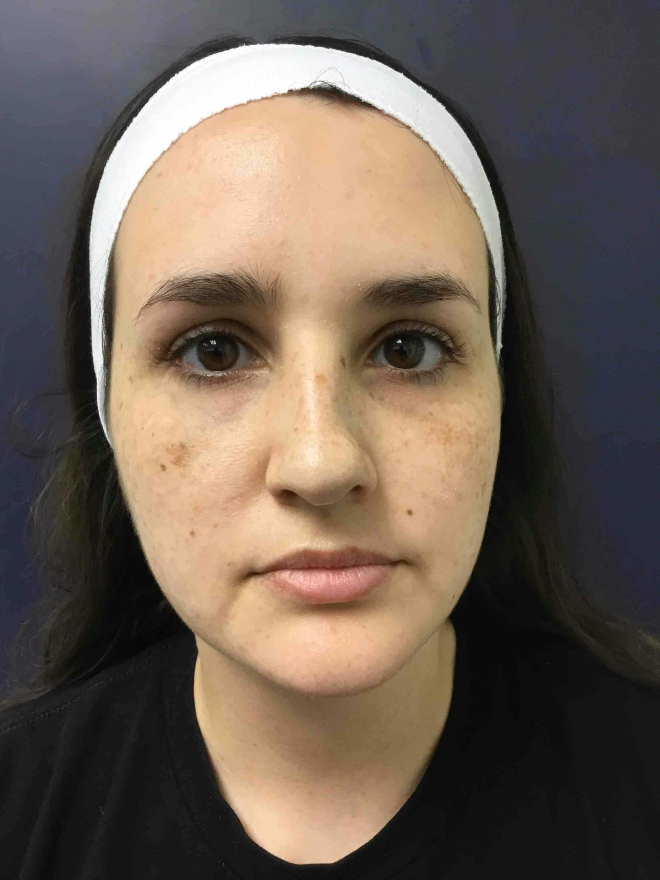 BBL™ Laser Before & After Gallery - Patient 168195 - Image 1