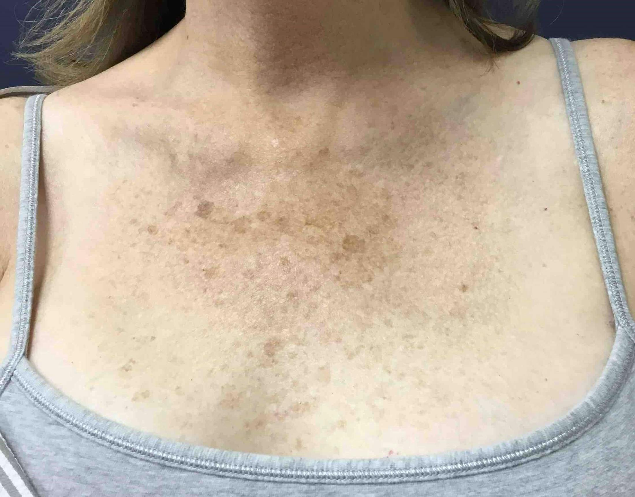 BBL™ Laser Before & After Gallery - Patient 263680 - Image 1